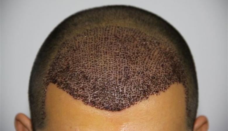 وفاة شخص في عملية زراعة شعر تحير الأطباء موقع رام الله الإخباري