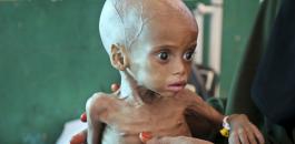 المجاعة في الصومال 
