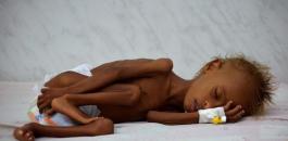 الجوع الشديد في اليمن 