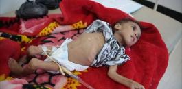  1500 وفاة بسبب الكوليرا في اليمن