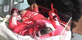 ازال دماغ زائد لرضيعة في غزة 