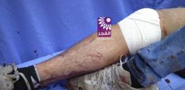إصابة شاب برصاص الاحتلال في طولكرم