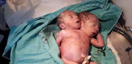 ولادة طفل سوري برأسين 