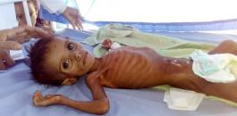 موت اطفال اليمن بسبب الجوع 