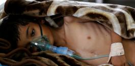 تفشي مرض الكوليرا في اليمن 