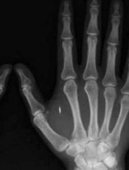 شركة تزرع رقاقات في أجساد موظفيها.. لماذا؟