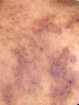 السودن والايدز 