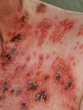 فيروس الايدز 