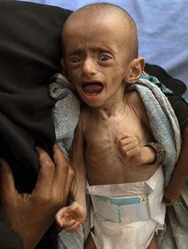 وفاة اطفال اليمن 