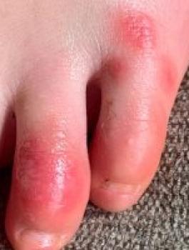 مصابي كورونا من الشباب 