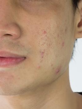 حب الشباب والطعام 