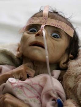 مجاعة في اليمن 