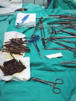 استخراج مسامير من داخل معدة مريض في جنين 