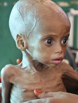 المجاعة في الصومال 