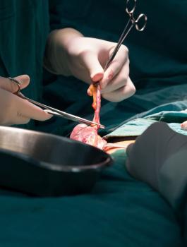 جراحون ينجحون في زراعة لسان 