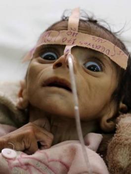 موت اطفال اليمن 