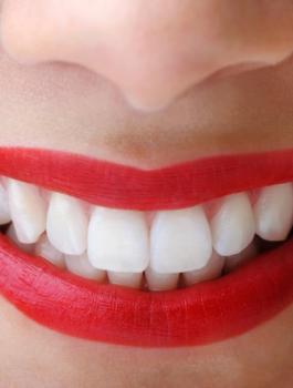 تبييض الأسنان 