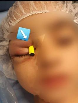 قلم يخترق عين فتاة في نابلس 