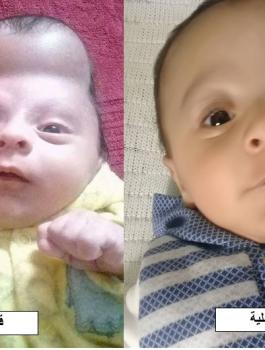 عملية جراحية نوعية لترميم الأغشية الدماغية لطفل في الشهر الثالث من العمر