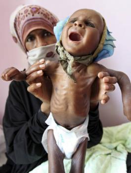 الكوليرا في اليمن 