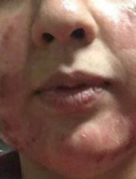 فتاة مصرية ذهب لصالون تجميل استعدادا لزفافها.. فخرجت مشوهة