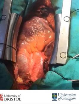 جراحون في مستشفى النجاح يجرون عملية نادرة 