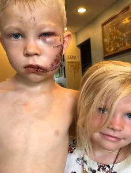 طفل تصدى لكلب لينقذ شقيقته 