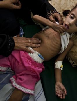 نصف مليون يمني مصاب بالكوليرا 