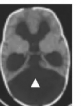 فيروس وبكتيريا والاطفال 
