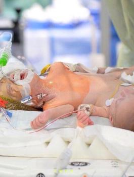 فصل التوأم السيامي فرح وحنين بالسعودية 