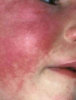 الحمى والاطفال 