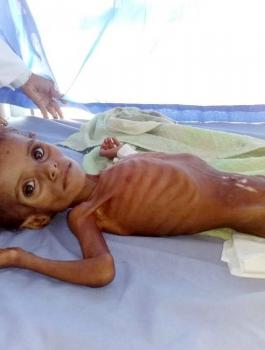 موت اطفال اليمن بسبب الجوع 