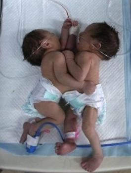 توام سيامي في غزة 