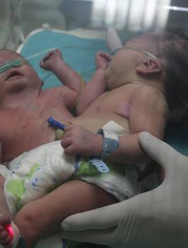 توام سيامي في غزة 