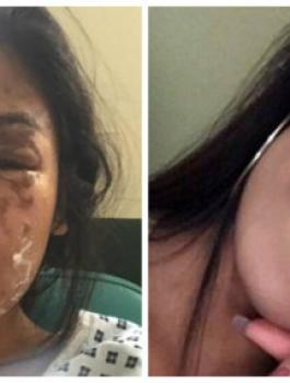 مسلمة بريطانية تتسامح مع متطرف كاره للاسلام شوه وجهها بماء النار