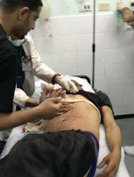 إصابة خطيرة بالصدر برصاص الاحتلال شرق خانيونس