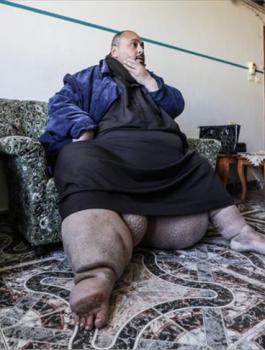 مرض الفيل في غزة 