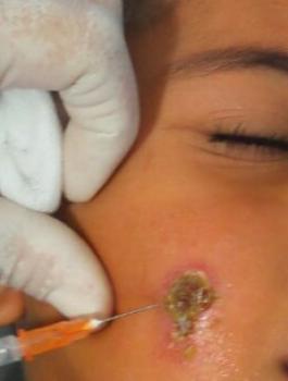 اللشمانيا 3(1)