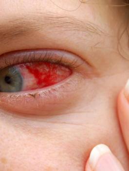 اصابة العين بالانفلونزا 