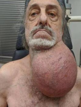 استئصال ورم ضخم من رقبة شخص بحجم كرة القدم 