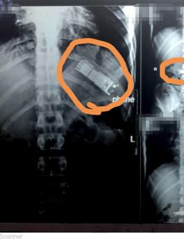 العثور على هاتف خلوي داخل معدة مصري 