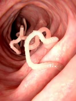 اكتشاف دودة شريطية داخل مواطن صيني 