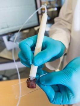 قلم يشخص السرطان في 10 ثوان