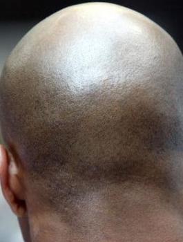 الصلع وفيروس كورونا 