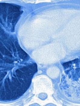 العلماء والالتهاب الرئوي