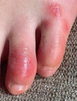 اصابة مراهقين بفيروس كورونا