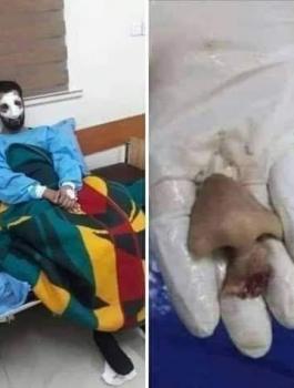 سيدة تقضم انف زوجها