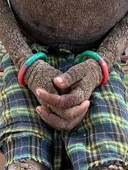 مرض نادر يحول بشرة طفلة الى حجارة