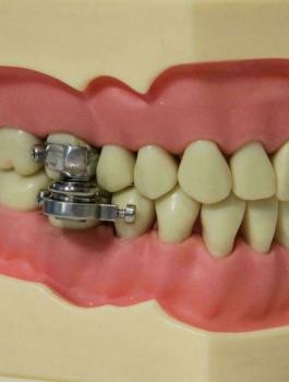 جهاز ربط الفكين.. ابتكار جديد لإنقاص الوزن