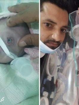 ولادة طفل يمني بعين واحدة